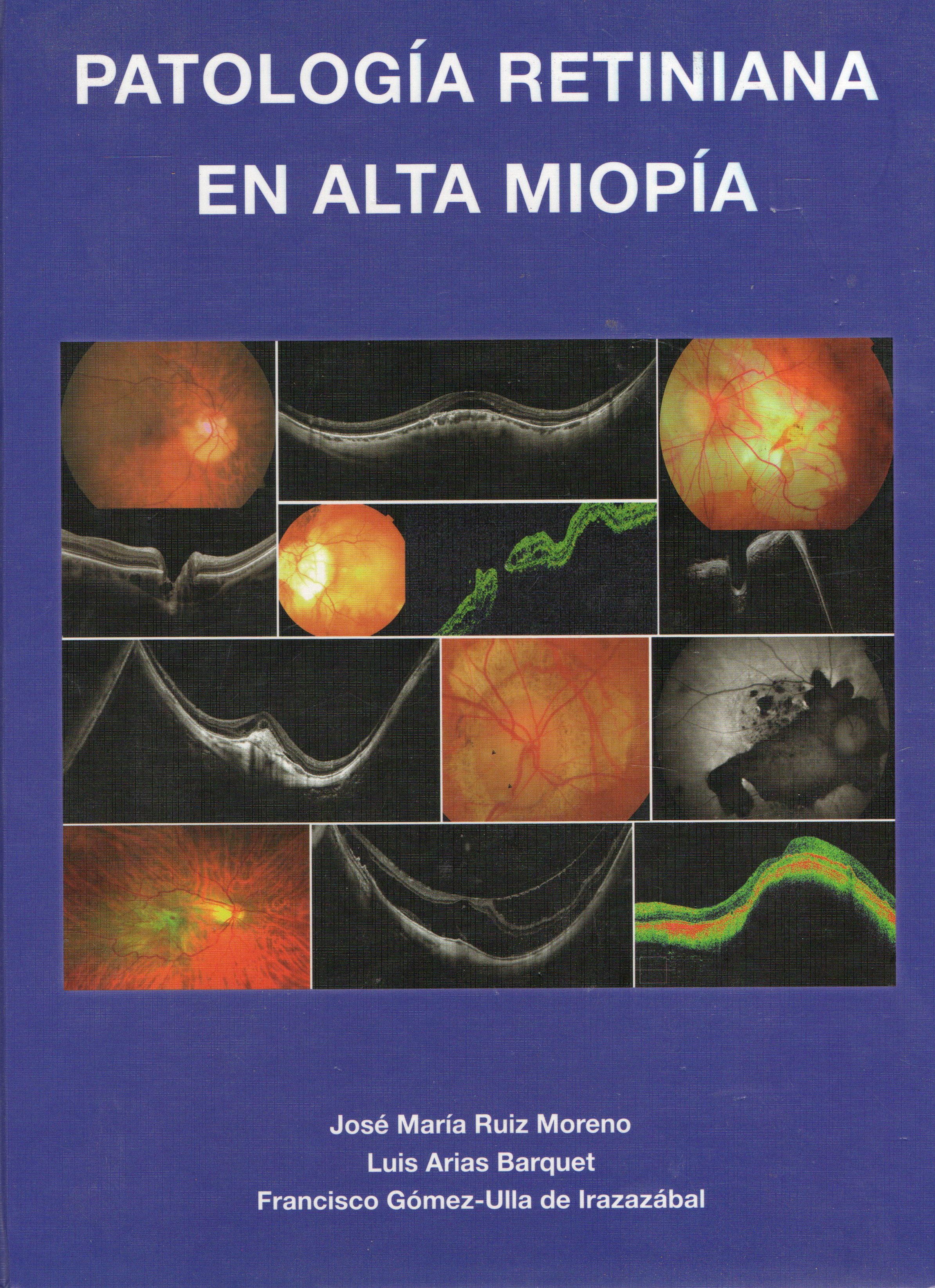 PATOLOGIA RETINIANA EN ALTA MIOPIA