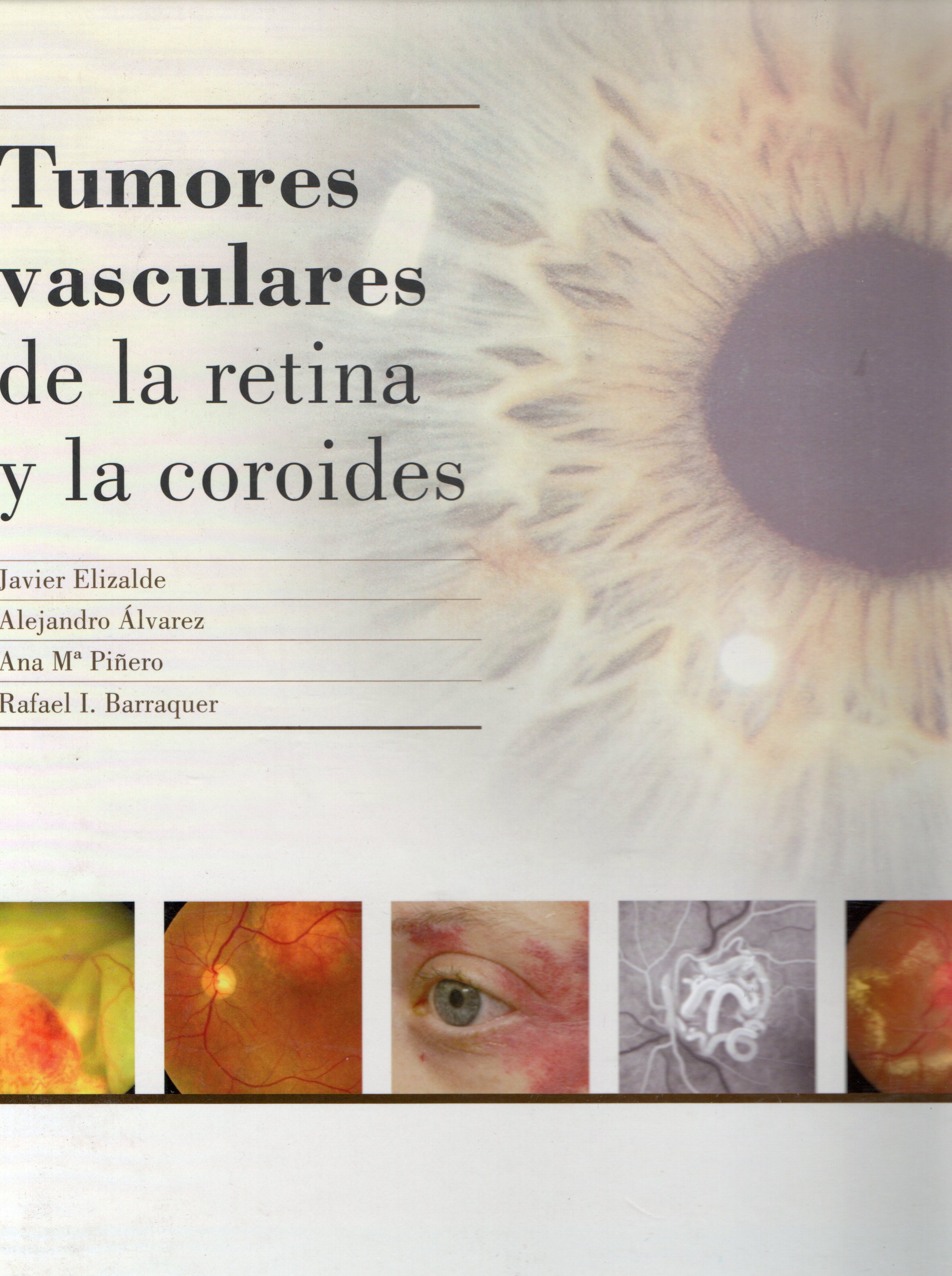 TUMORES VASCULARES DE LA RETINA Y LA COROIDES