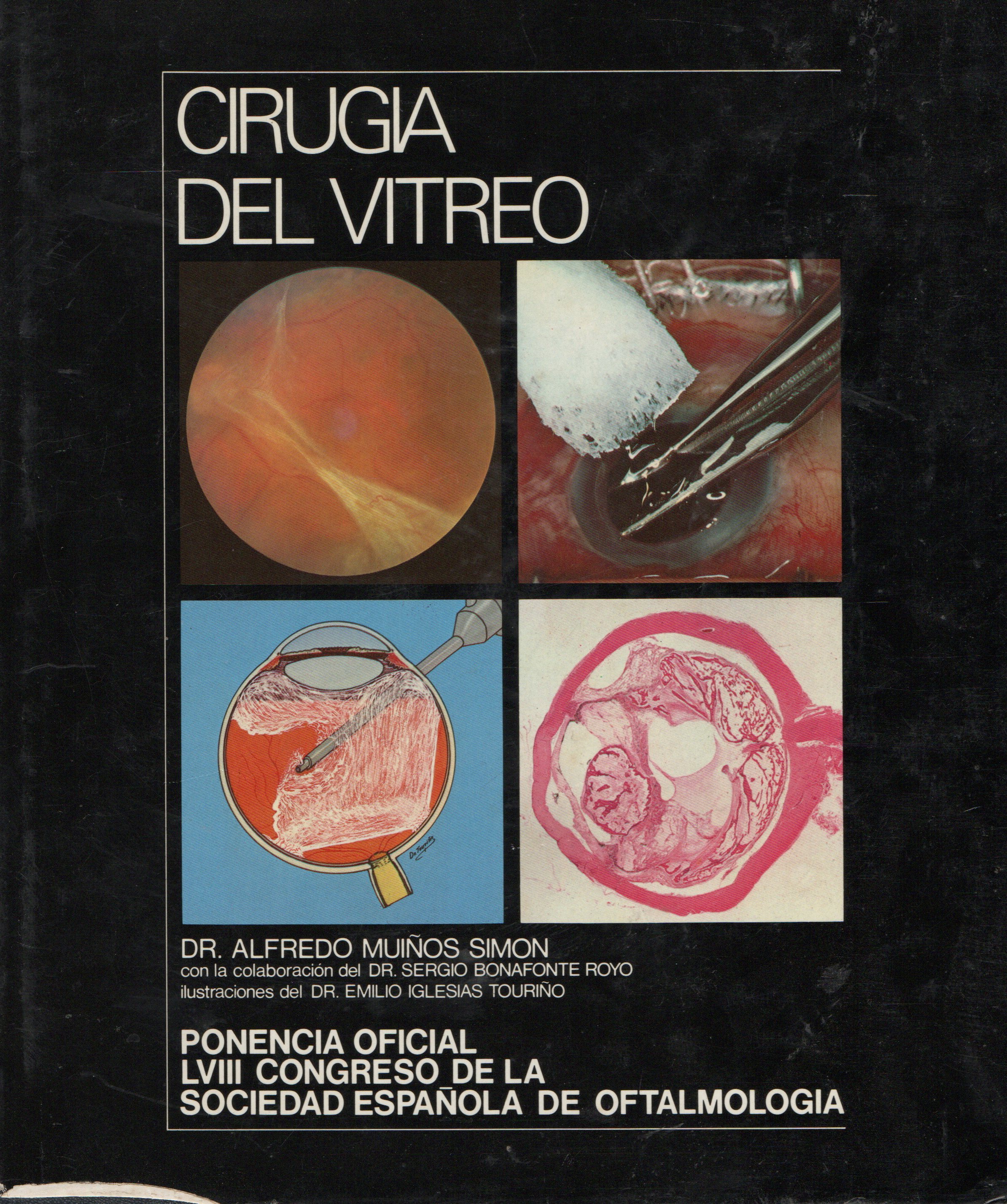 CIRUGIA DEL VITREO