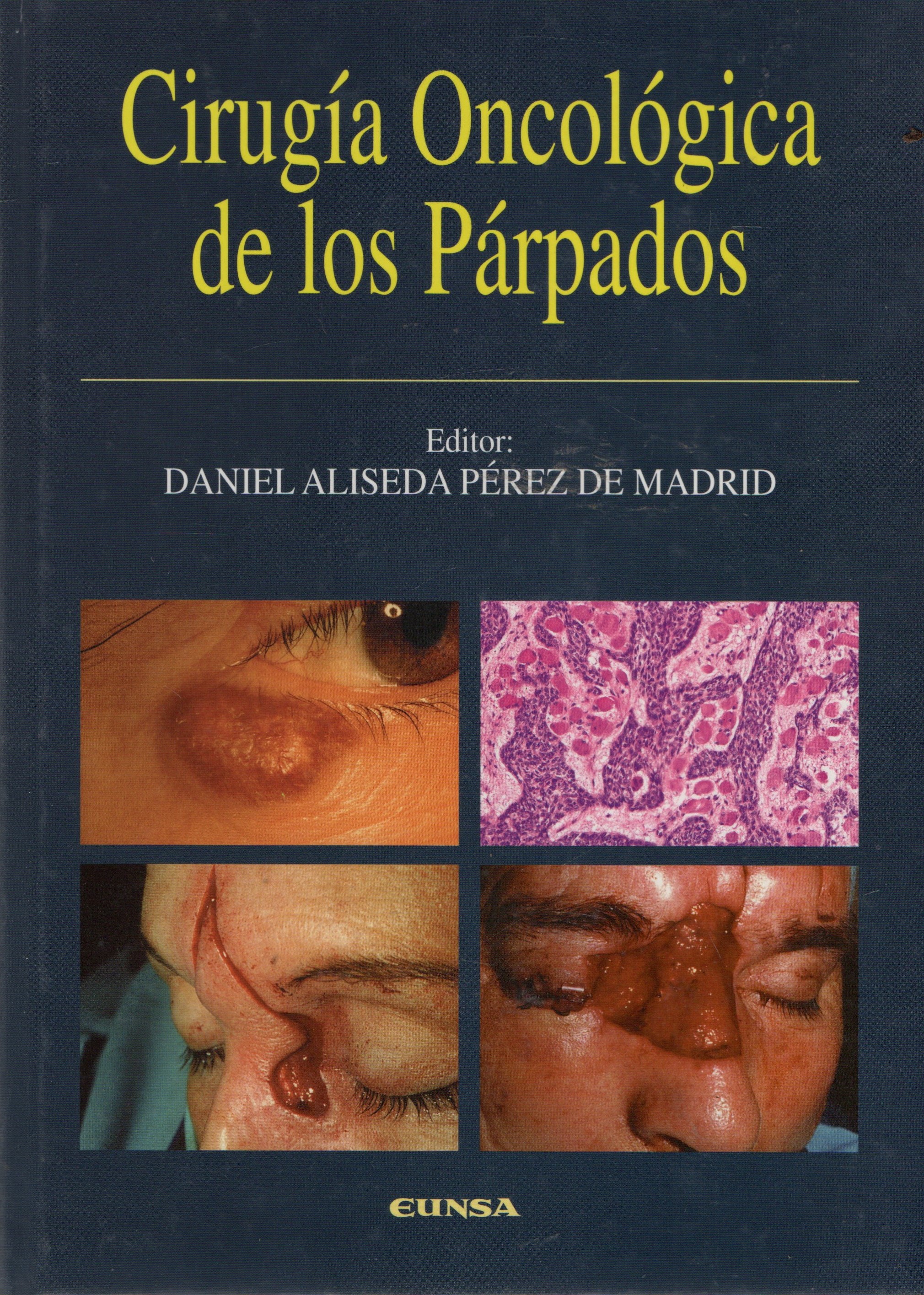 CIRUGIA ONCOLOGICA DE LOS PARPADOS