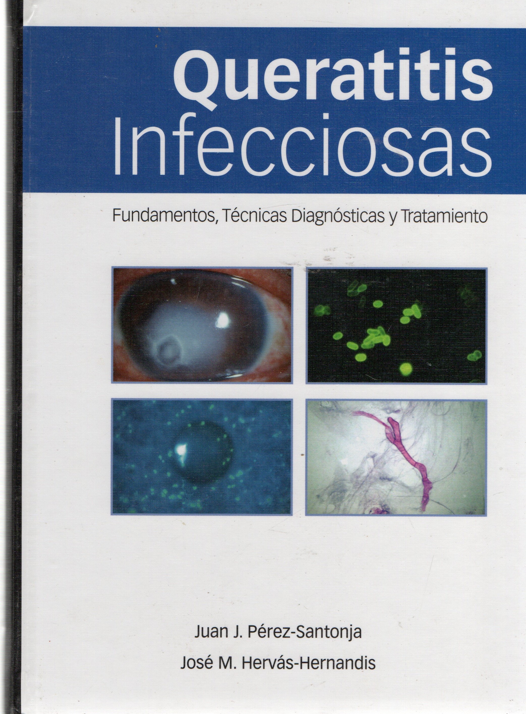 QUERATITIS INFECCIOSAS
