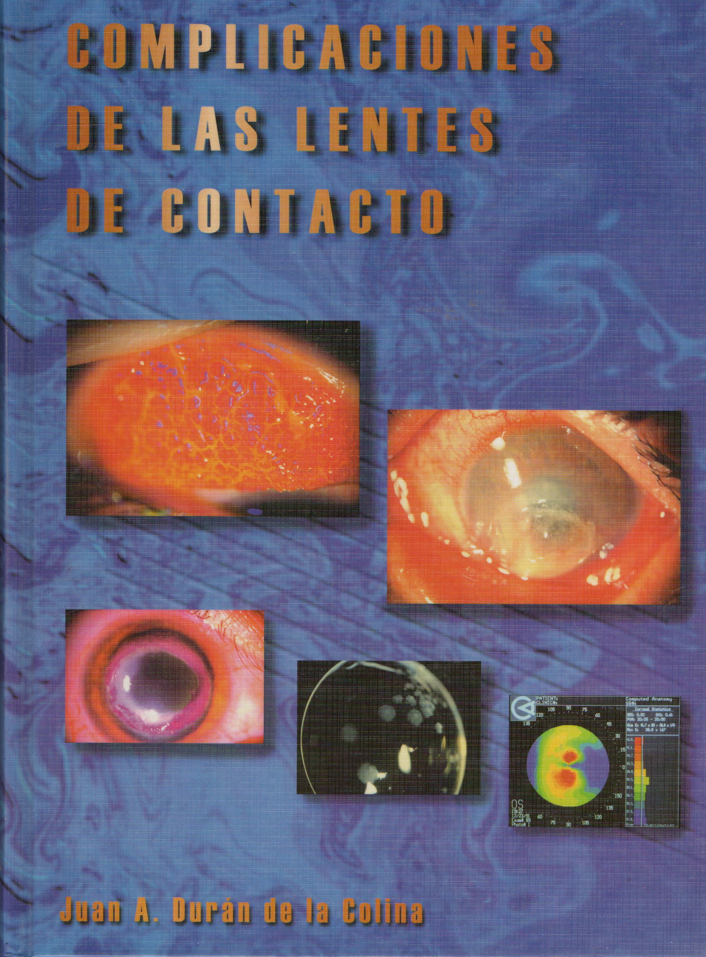 COMPLICACIONES DE LAS LENTES DE CONTACTO
