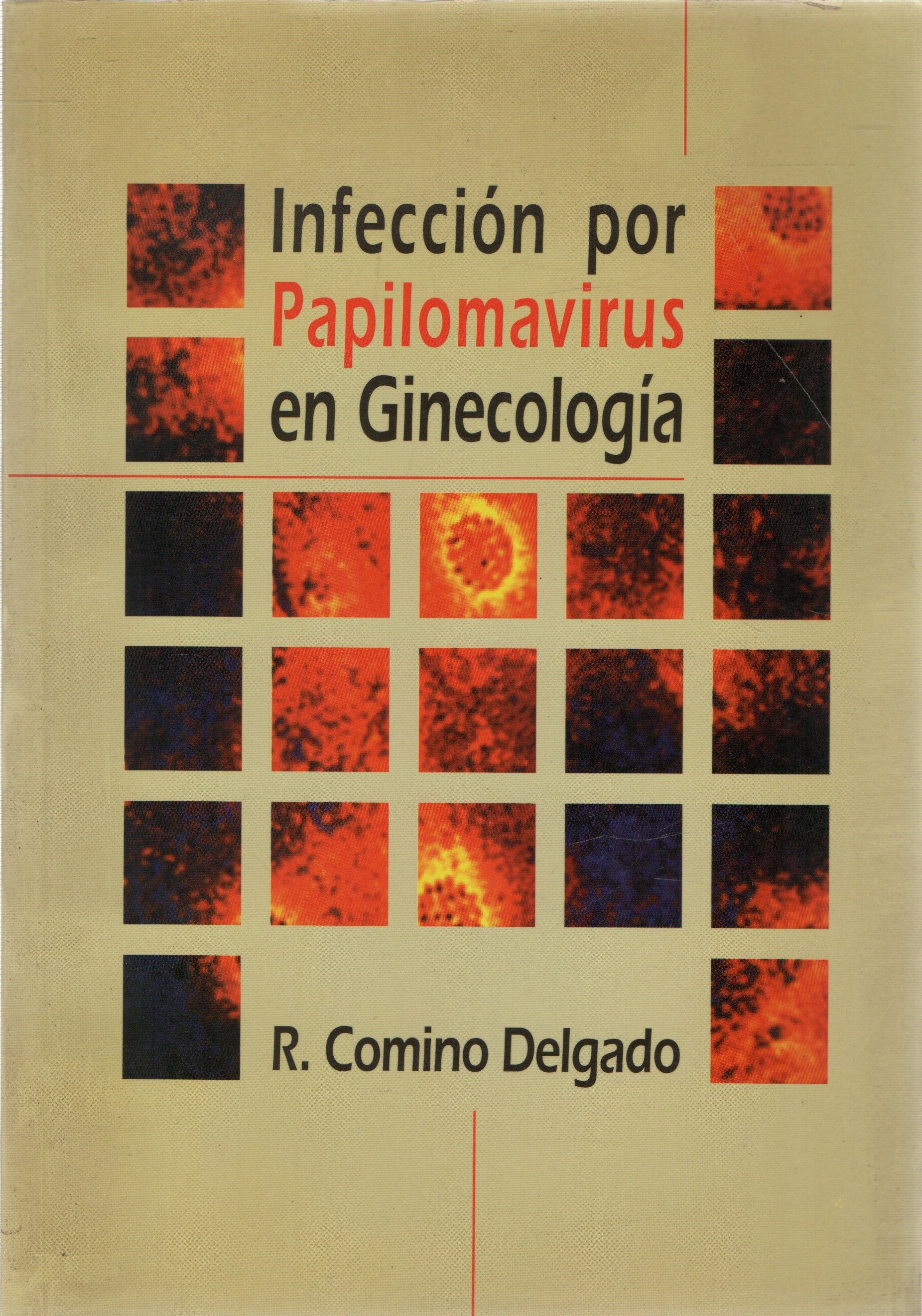 INFECCION POR PAPILOMAVIRUS EN GINECOLOGIA