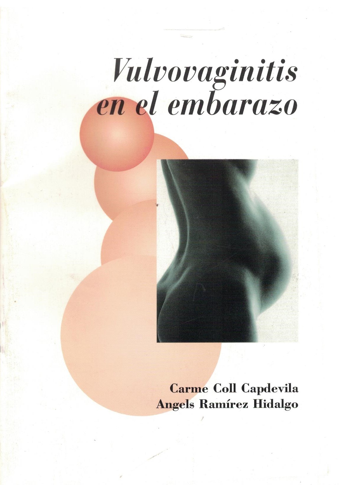 VULVOVAGINITIS EN EL EMBARAZO