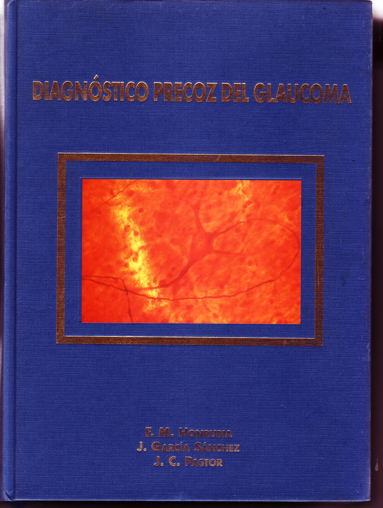 DIAGNOSTICO PRECOZ DEL GLAUCOMA