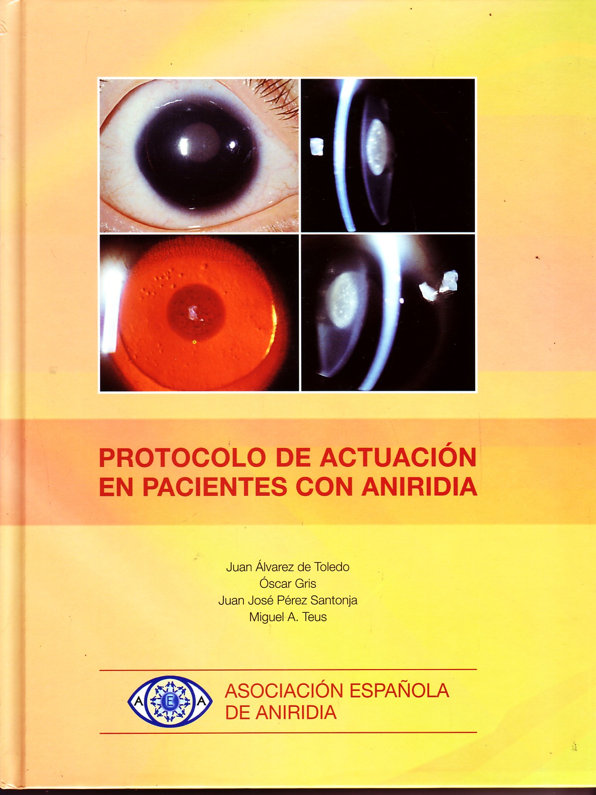 PROTOCOLO DE ACTUACION EN PACIENTES CON ANIRIDIA
