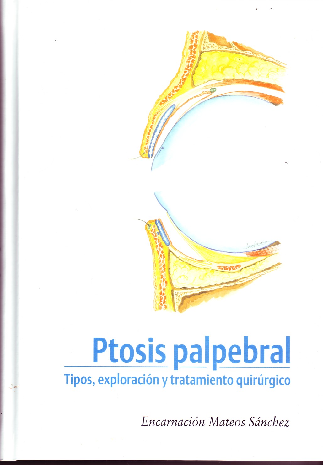 PTOSIS PALPEBRAL. TIPOS, EXPLORACION Y TRATAMIENTO QUIRURGICO.