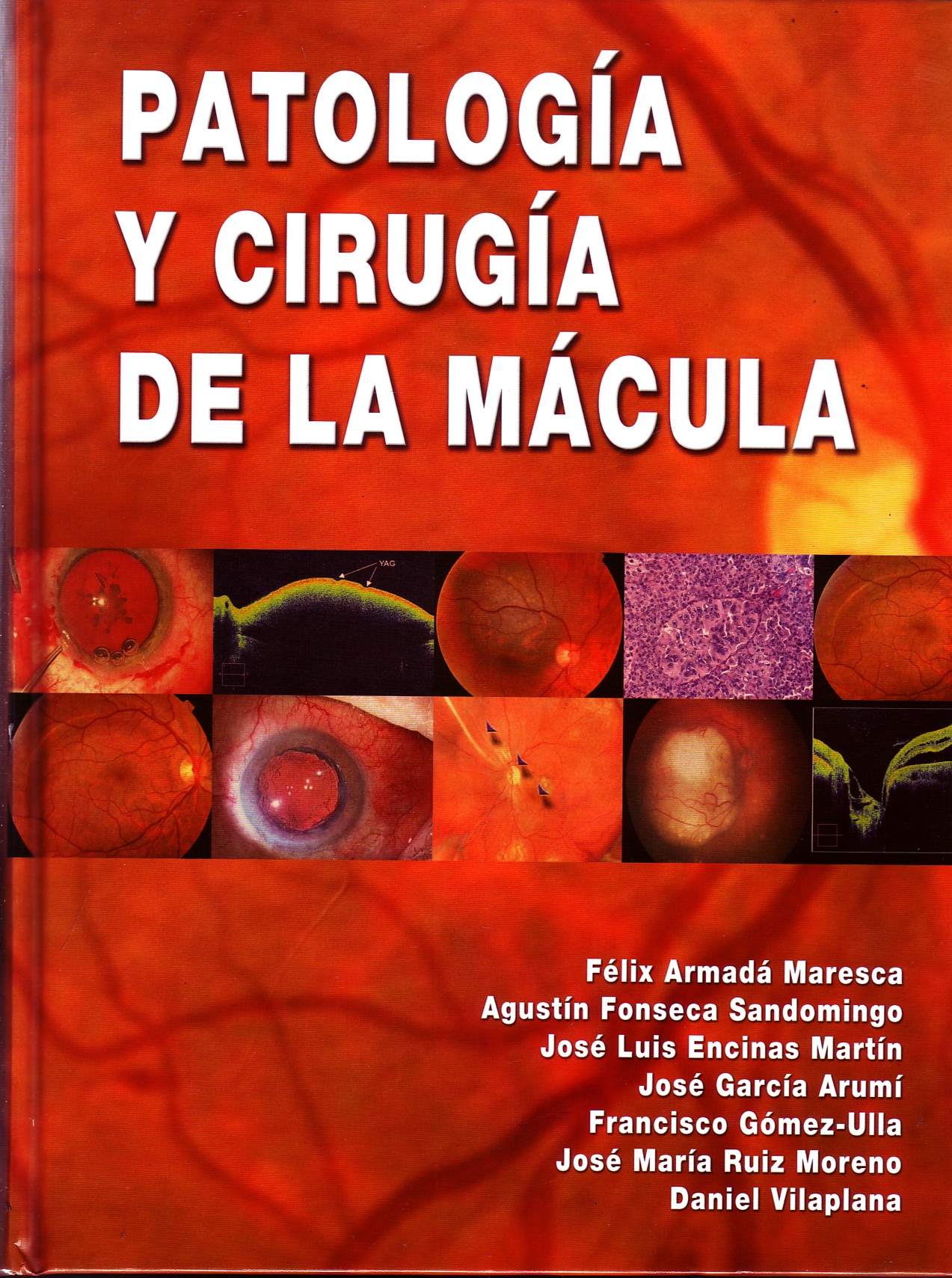 PATOLOGIA Y CIRUGIA DE LA MACULA.
