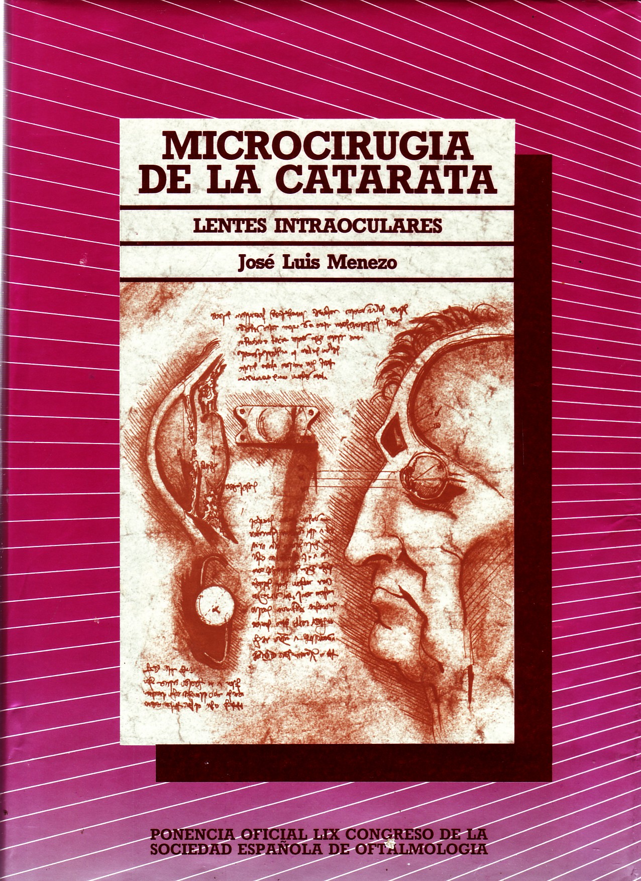 MICROCIRUGIA DE LA CATARATA. LENTES INTRAOCULARES.