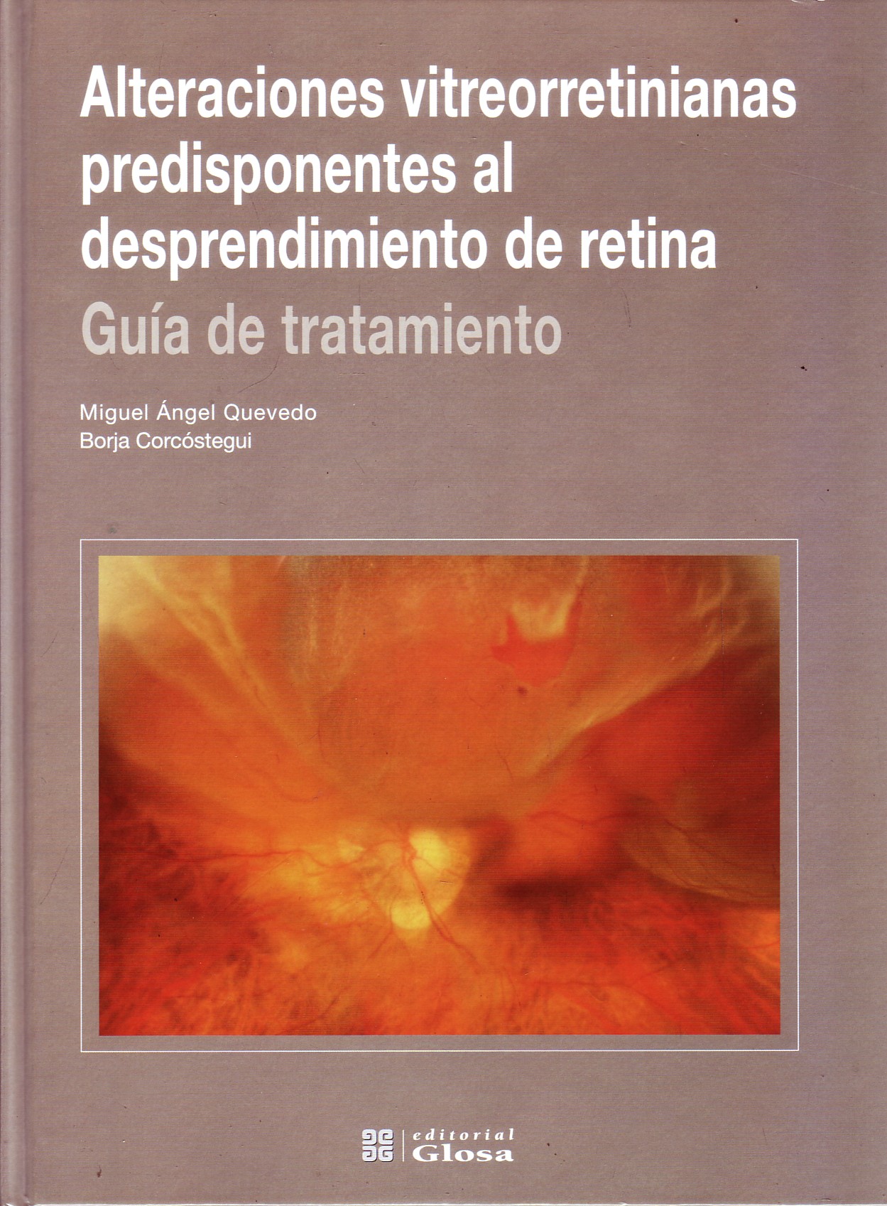 ALTERACIONES VITREORRETINIANAS PREDISPONENTES AL DESPRENDIMIENTO DE RETINA. GUIA DE TRATAMIENTO.