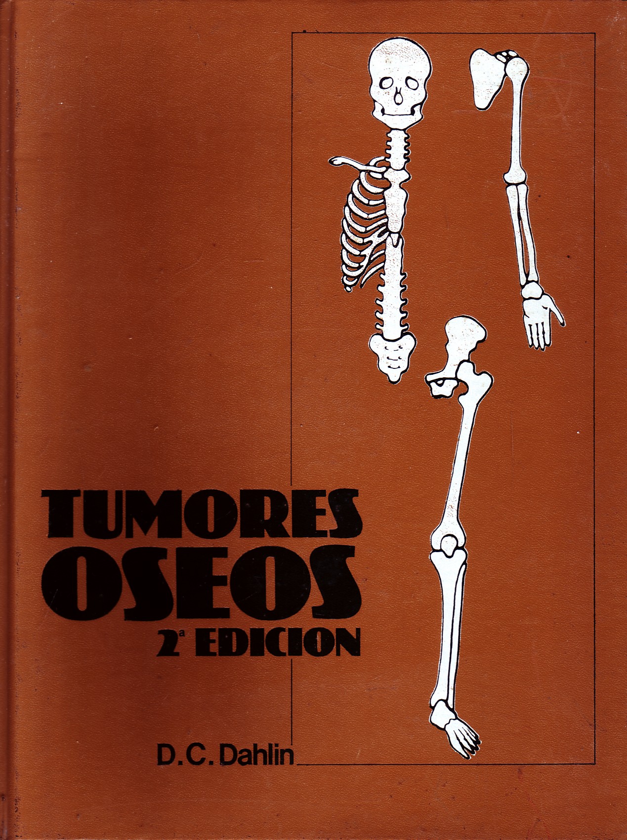 TUMORES OSEOS