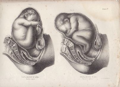 LITOGRAFIA DE MEDICINA.  4ª POSICION DE NALGAS Y 3ª DE PIES. LAMINA 38ª. LIT. DE DONON