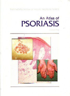 AN ATLAS OF PSORIASIS